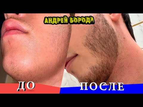 Видео: Зачем Роллер для Бороды / Минокс До и После / Андрей Борода / Выпуск № 14 "Как отрастить бороду"