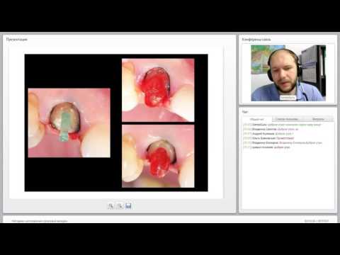 Видео: 2014 09 02 Методики изготовления культевой вкладки  0001