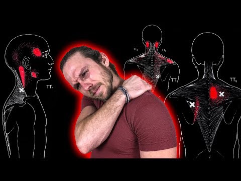 Видео: ЖГУЧАЯ БОЛЬ в СПИНЕ в области ЛОПАТОК, ПЛЕЧА, ШЕИ и ГОЛОВЫ 🔴 Триггерные точки в трапециевидной мышце