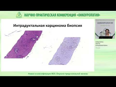 Видео: Новое в классификации ВОЗ  Опухоли предстательной железы