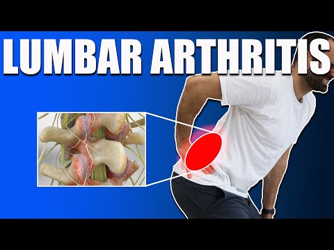 Видео: Синдром пояснично-фасеточного сустава: причины, симптомы и эффективные методы лечения боли в пояс...