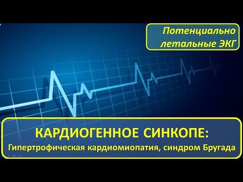 Видео: Кардиогенное синкопе и потенциально летальные ЭКГ: гипертрофическая кардиомиопатия и синдром Бругада