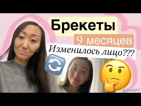 Видео: 9 МЕСЯЦЕВ В БРЕКЕТАХ🙃//ИЗМЕНИЛОСЬ ЛИЦО??? 🤔МУЧАЕТ СТОМАТИТ😖