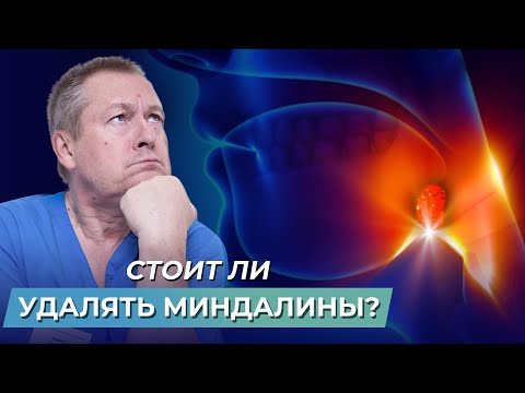 Видео: Нужно ли удалять аденоиды и миндалины? Простое лечение воспаления гланд