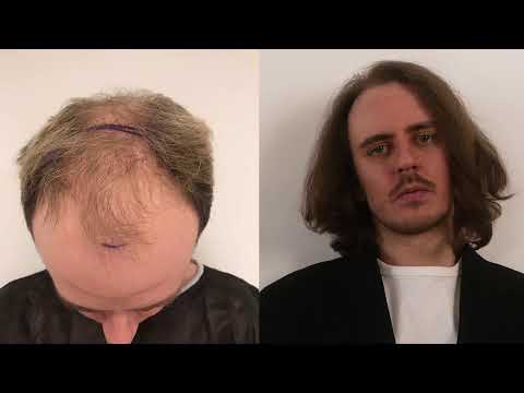 Видео: Послезавтра лечу на пересадку волос (вторую) Отвечаю на вопросы