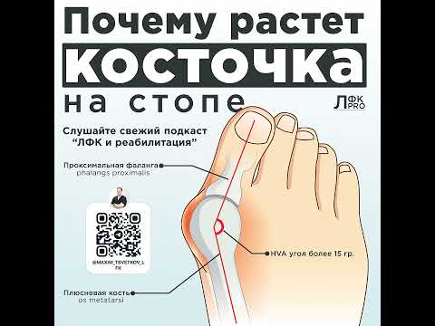 Видео: Почему растет косточка на стопе?