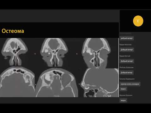Видео: Компьютерная томография при опухолях придаточных пазух носа