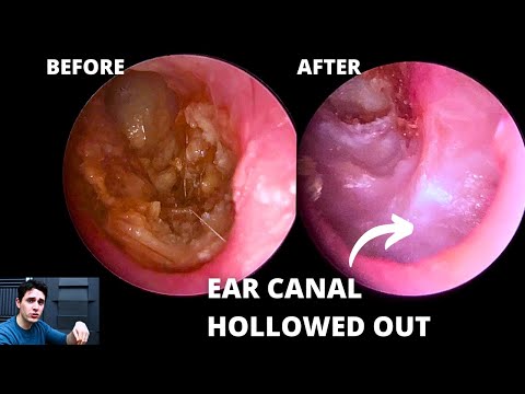 Видео: Важность угловых эндоскопов (скрытая патология)