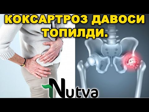 Видео: КОКСАРТРОЗ ДАВОСИ ТОПИЛДИ