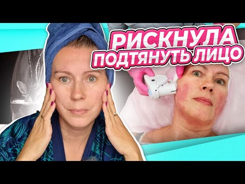 Видео: РЕЗАТЬ НЕ ХОЧУ ПОДТЯЖКА | SMAS СМАС лифтинг ОПЫТ ЦЕНЫ АППАРАТЫ КОНСУЛЬТАЦИЯ