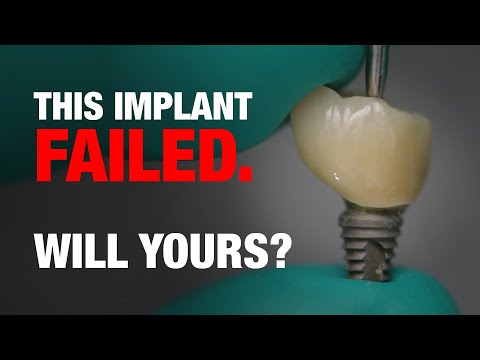 Видео: Вы разрабатываете имплантаты, которые ОБЯЗАТЕЛЬНО ПОТЕРПЯТ НЕУДАЧУ, и даже не знаете об этом!
