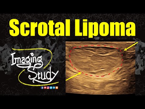 Видео: Липома мошонки || Ультразвуковое исследование || Случай 359