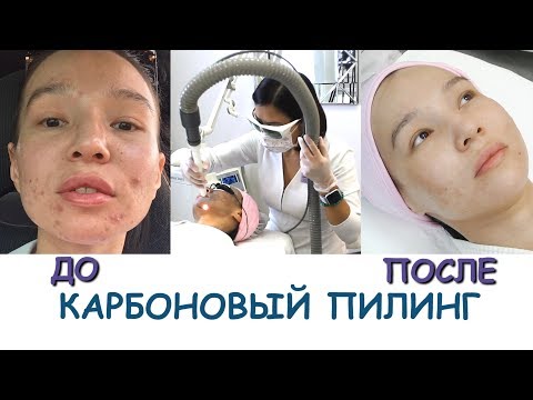 Видео: Лазерный КАРБОНОВЫЙ ПИЛИНГ💖 ДО и ПОСЛЕ!!!