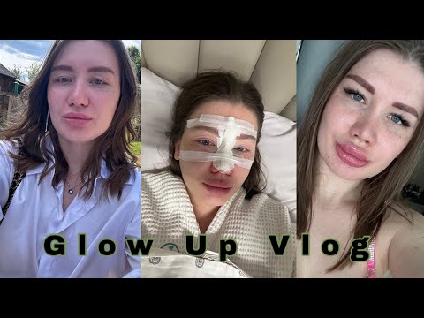 Видео: Glow up vlog: ринопластика, восстановление после ринопластики, губы, перманент бровей