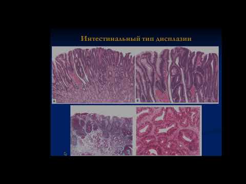 Видео: Электив. Опухоли ЖКТ