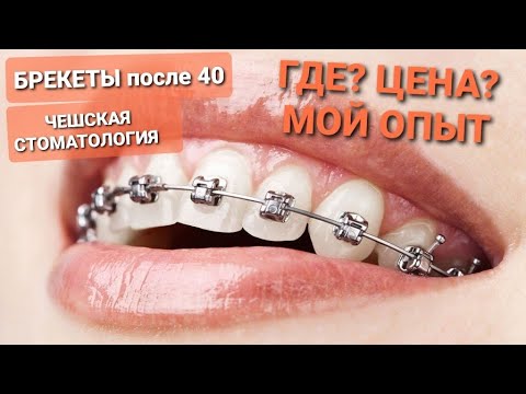 Видео: ЧЕХИЯ. БРЕКЕТЫ после 40 ЛЕТ. ГДЕ СТАВИТЬ, ЦЕНА, ГИГИЕНА, АДАПТАЦИЯ. ОБЗОР. ЧЕШСКАЯ СТОМАТОЛОГИЯ