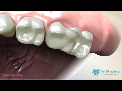 Видео: #ортодонт #брекети #консултация Първа консултация с ортодонт- какво трябва да знаем и защо е важна?