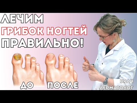Видео: Грибок ногтей: Все способы лечения онихомикоза – Как избавиться навсегда! (От дерматолога)