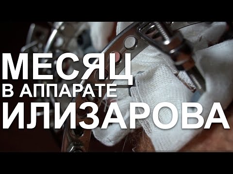 Видео: Месяц в аппарате Илизарова