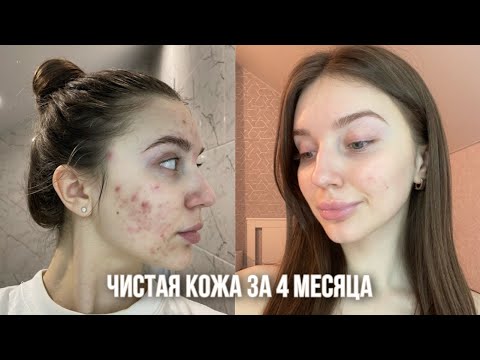 Видео: Как я вылечила АКНЕ 🤍| Моя история лечения кожи| АКНЕКУТАН | Уход за кожей