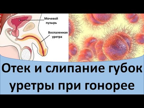 Видео: Отек и слипание губок уретры при гонорее