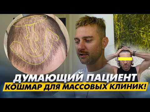 Видео: А почему нельзя принимать быстрые решения? Планирование пересадки волос | KRASAV4IK