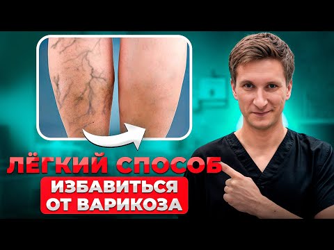 Видео: КАК Избавиться от Сосудистой сетки и Варикоза НАВСЕГДА? Рекомендации Флеболога
