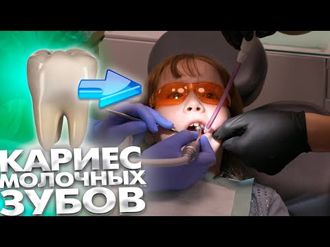 Видео: Как проходит лечение кариеса молочных зубов?