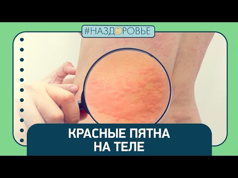 Видео: #НАЗДОРОВЬЕ: красные пятна на теле