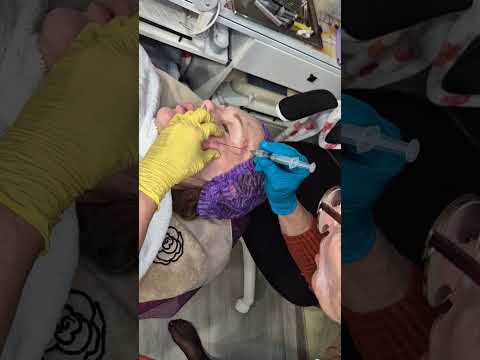 Видео: Биореви канюля . 