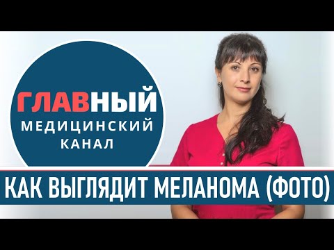 Видео: Как выглядит МЕЛАНОМА (фото 1-9). Симптомы и признаки меланомы. Как определить рак кожи