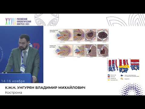 Видео: Лечение пациентов с метастатической увеальной меланомой методом изолированной химиоперфузии печени