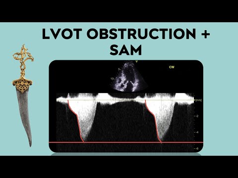 Видео: Острота левого желудочка и сенсибилизация левого желудочка в отделении неотложной помощи/реанимац...