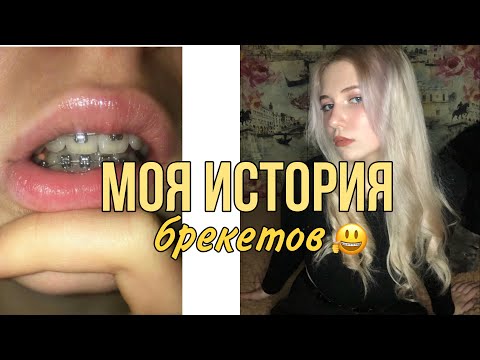 Видео: Брекеты/до после/моя история