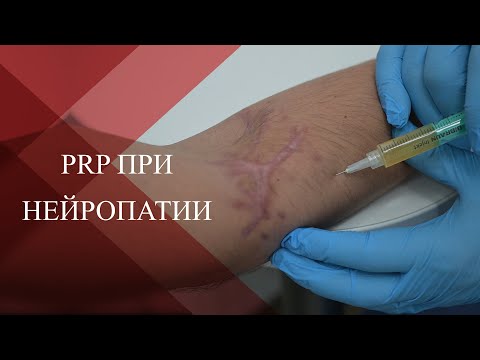 Видео: 💉PRP терапия при  посттравматической нейропатии в следствии травм и ранений