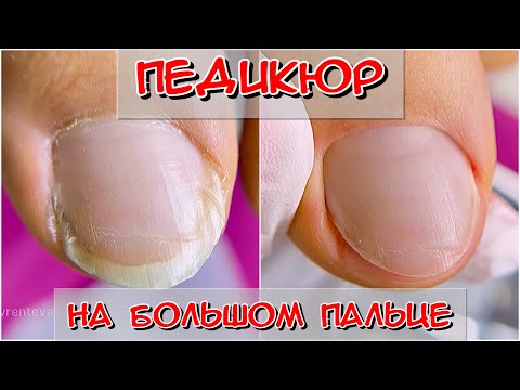 Видео: Педикюр на большой палец / Комбинированный педикюр / Средства для педикюра / #Nails #Ногти #педикюр