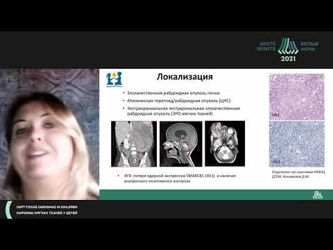 Видео: Злокачественные рабдоидные опухоли мягких тканей у детей: клиника и текущие подходы к терапии