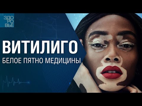 Видео: Витилиго. Белое пятно медицины. На здоровье 08.03.2025