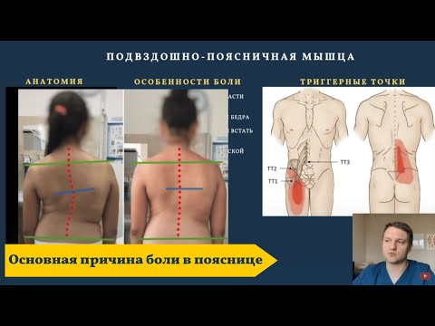 Видео: Подвздошно-поясничная мышца. Основная причина боли в пояснице