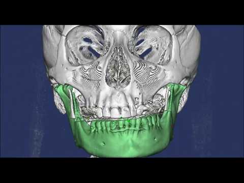 Видео: Анализ движений нижней челюсти с визуализацией суставов