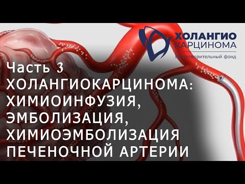 Видео: ЧАСТЬ 3. ХОЛАНГИОКАРЦИНОМА: ХИМИОИНФУЗИЯ, ЭМБОЛИЗАЦИЯ, ХИМИОЭМБОЛИЗАЦИЯ ПЕЧЕНОЧНОЙ АРТЕРИИ // РНЦРХТ