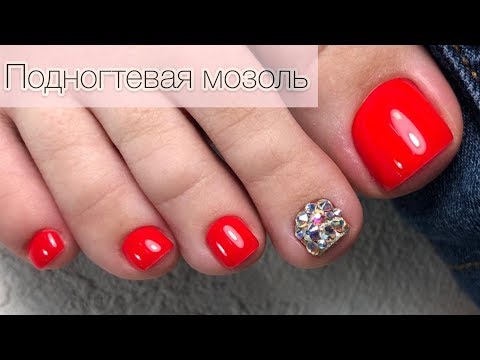 Видео: ЭСТЕТИЧЕСКИЙ ПЕДИКЮР. Удаление подногтевой МОЗОЛИ. Классика жанра.