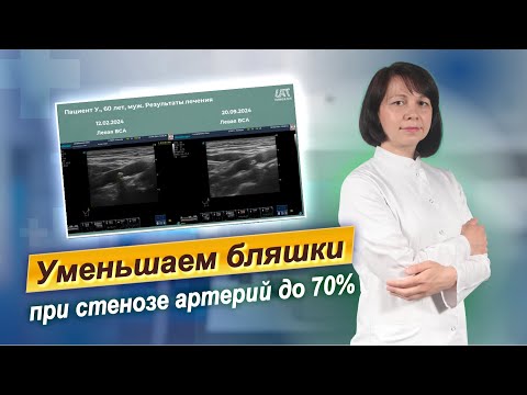 Видео: Бляшки в сосудах шеи до 70%. Медицинский кейс.