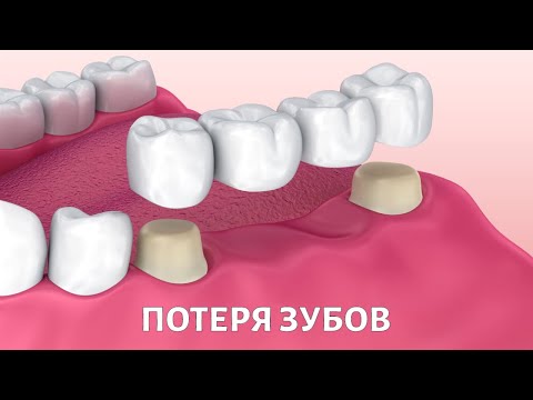 Видео: Потеря ЗУБОВ: каковы последствия и как с ними бороться?