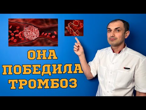 Видео: Как женщина за 2 недели растворила тромб. Флеболог Москва.