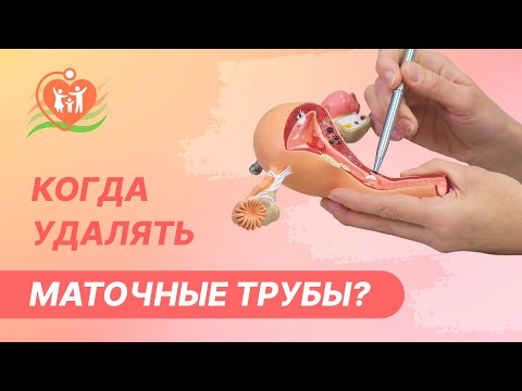 Видео: 👩‍⚕️  Когда удалять маточные трубы?