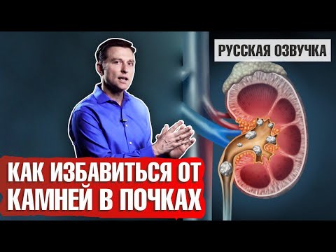 Видео: Камни в почках: Как избавиться? (русская озвучка)