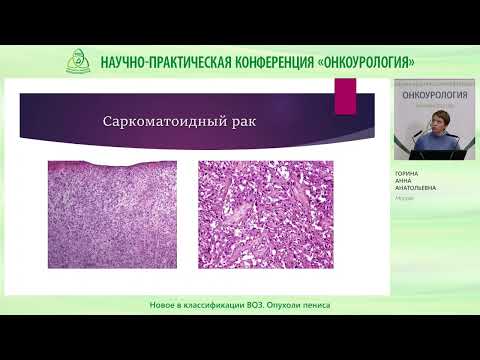 Видео: Новое в классификации ВОЗ  Опухоли пениса