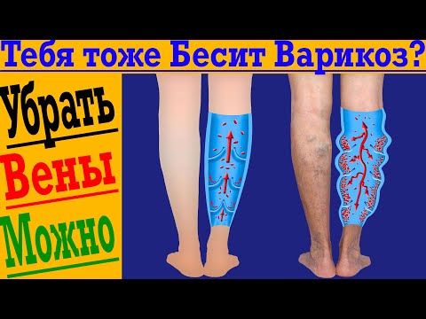 Видео: ВАРИКОЗА БОЛЬШЕ НЕТ ! Как убрать варикозные вены?!
