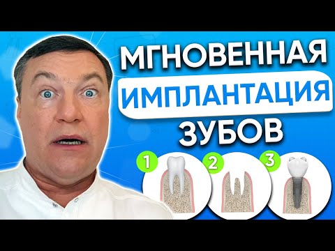 Видео: Удаление зуба и установка ИМПЛАНТА одновременно. МГНОВЕННАЯ имплантация зубов